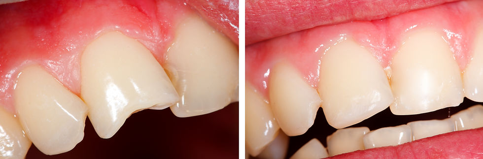Emergency Dental Care of Portland, Gresham, Happy Valley, Milwaukie, OR 97216 Same Day & Walk-Ins Welcome Emergency Dentist - Dental Checkup, Cleaning & Examinations, Crowns, Bridges, Implants, Restorations, Veneers & Laminates, Bonding, Fillings, Dentures, Partial Dentures, Smile Makeover, Teeth Whitening, Tooth Extractions, Kid Friendly Dentist, Periodontics, Root Canal Therapy