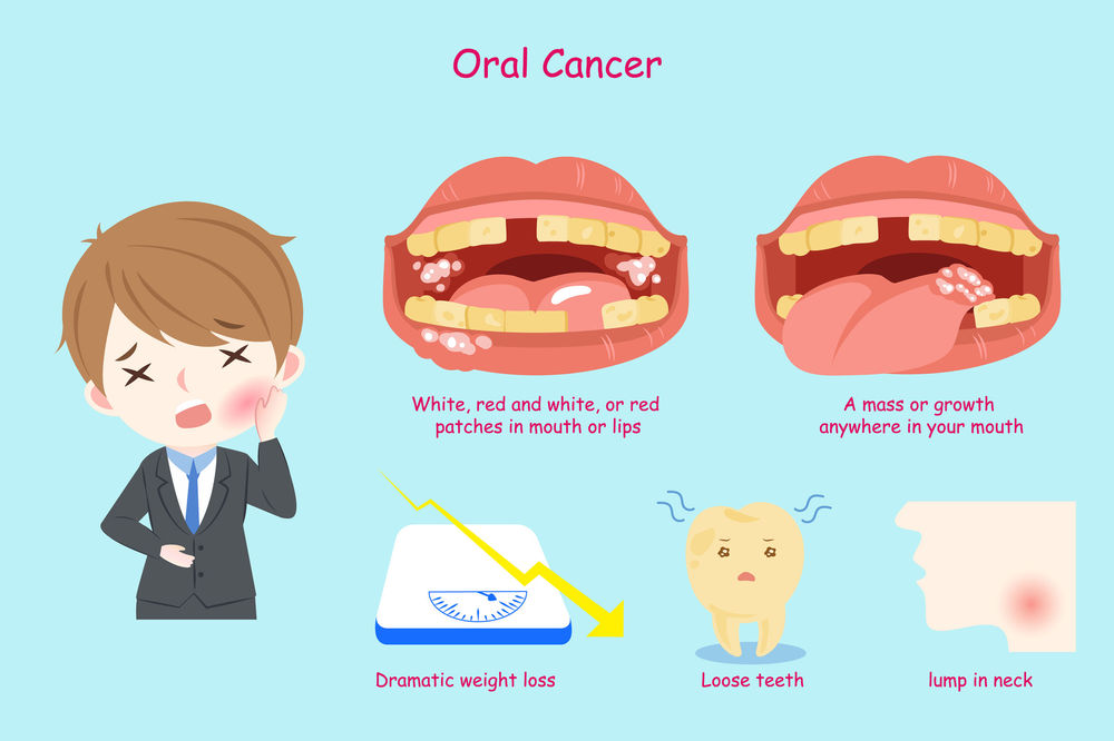 Why Should You Get Screened for Oral Cancer? Oral Cancer Awareness