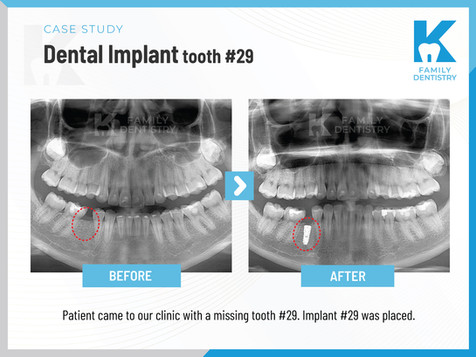 K Family Dentistry in Pflugerville, TX 78660 Emergency, Invisalign, Family ,Cosmetic - Dental Implants, Crowns, Bridges, Restorations, Veneers, Filling, Root Canal Therapy, ClearCorrect, Dentures, Teeth whitening, Inlays and onlays, Sedation Dentistry, Emergency Dentist, Kid Friendly Dentist, Dental Checkup, Cleaning & Examinations
