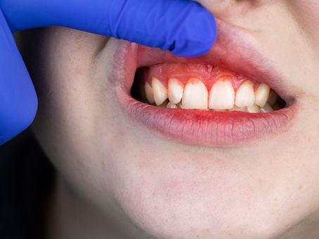 Can Gum Disease Be Healed? Yes! Your General Dentist in Fort Worth, Texas Explains How