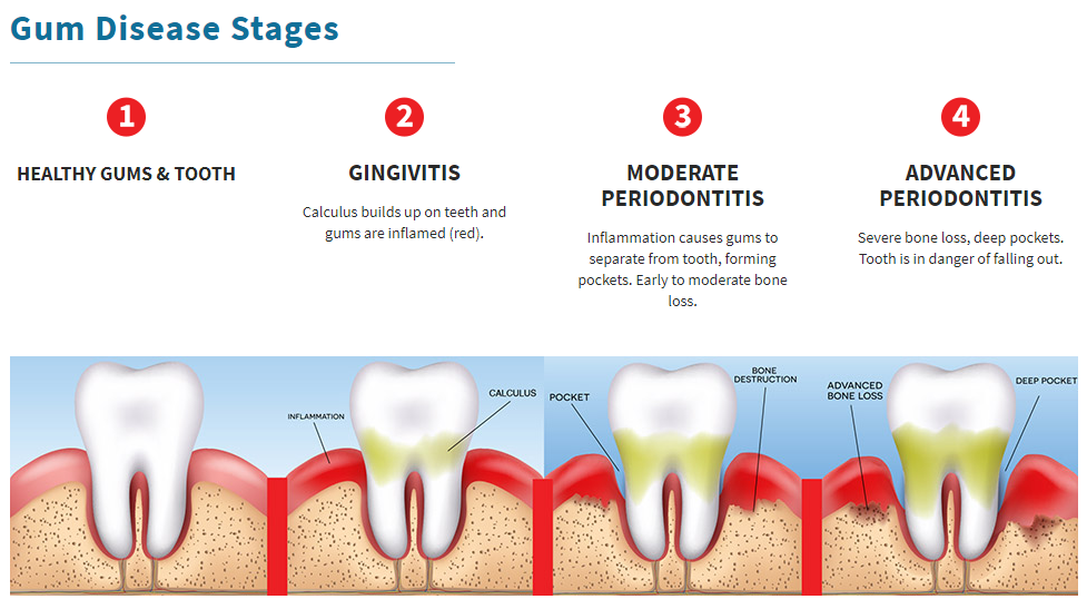 Understanding the Stages of Gum Disease