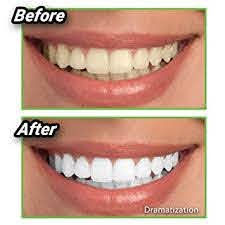 Miniatura: blanqueador de diente