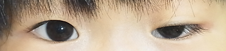 先天下垂術前.png