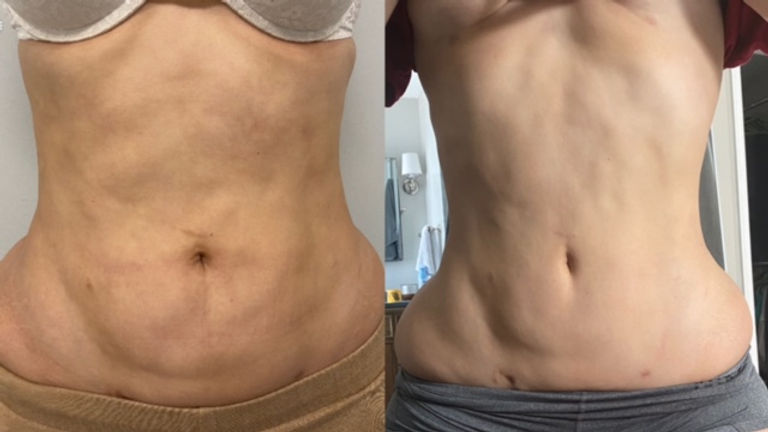 How to Find a Qualified Post-Surgery Lymphatic Therapist in Melbourne