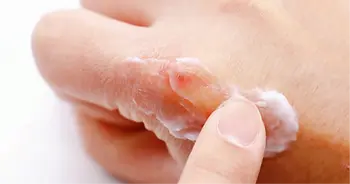 Urea in skincare for dry eczema prone skin