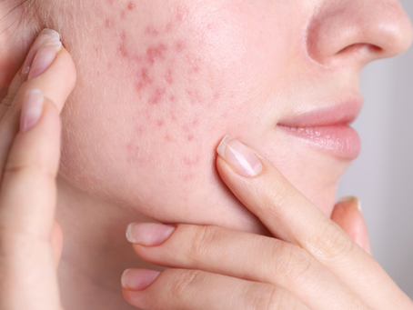 Acne-Prone and Sensitive Skin: The Role of Innovation and Formulation