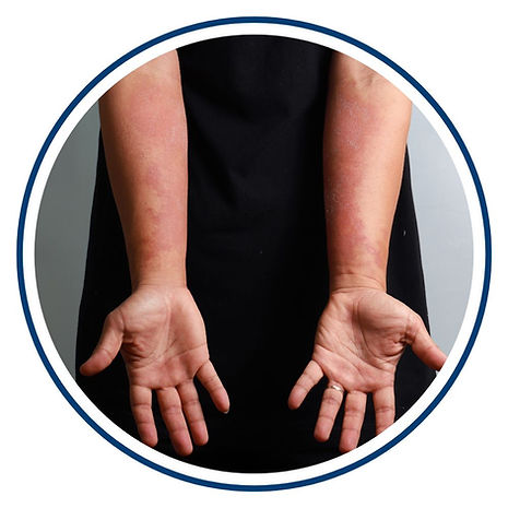 Managing-Eczema-Eczema-Association-of-Australasia.jpg