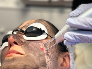 Carbon Laser Therapy (Carbon Peel Facial)