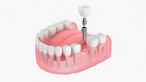 Conventional_Implants.gif