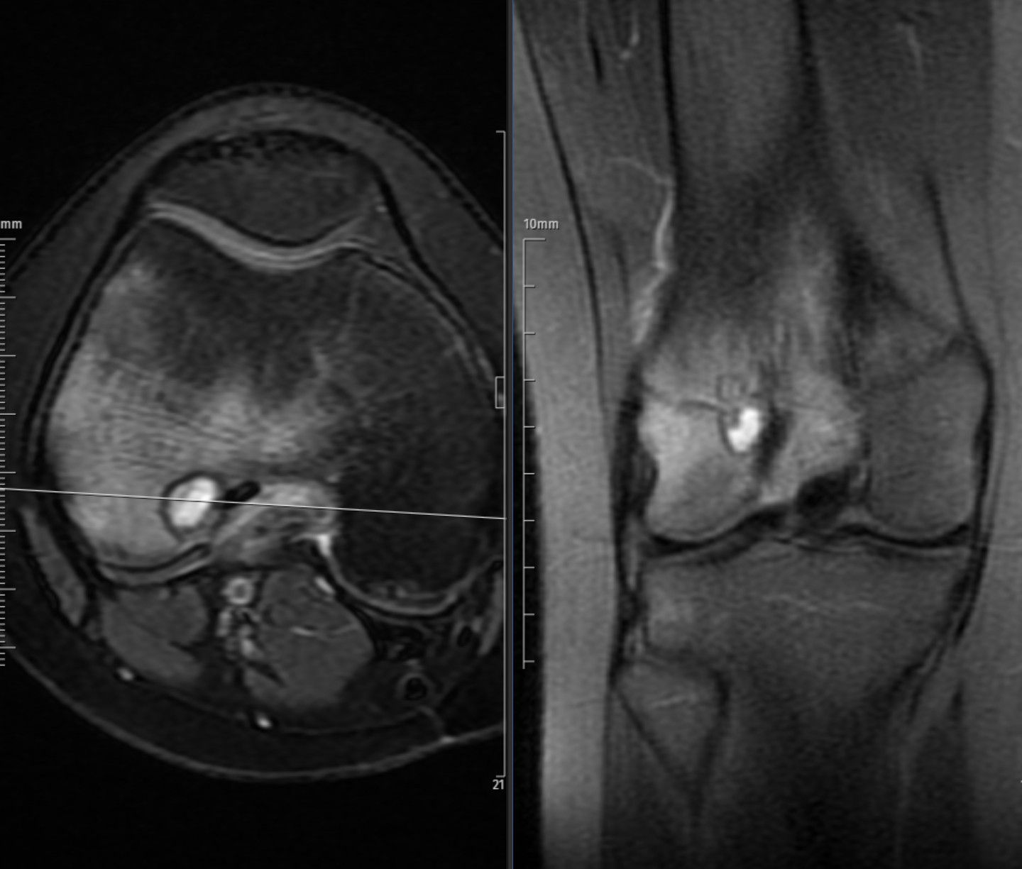 Axial and coronal fat-suppressed proton-density MRI images of the distal femur demonstrate a well-defined lobulated lesion in the epiphyseal region, showing heterogeneous high signal with a thin hypointense rim and surrounding bone marrow and soft-tissue edema. The lesion abuts the subchondral bone without cortical destruction. Findings are consistent with a chondroblastoma in a skeletally immature patient.