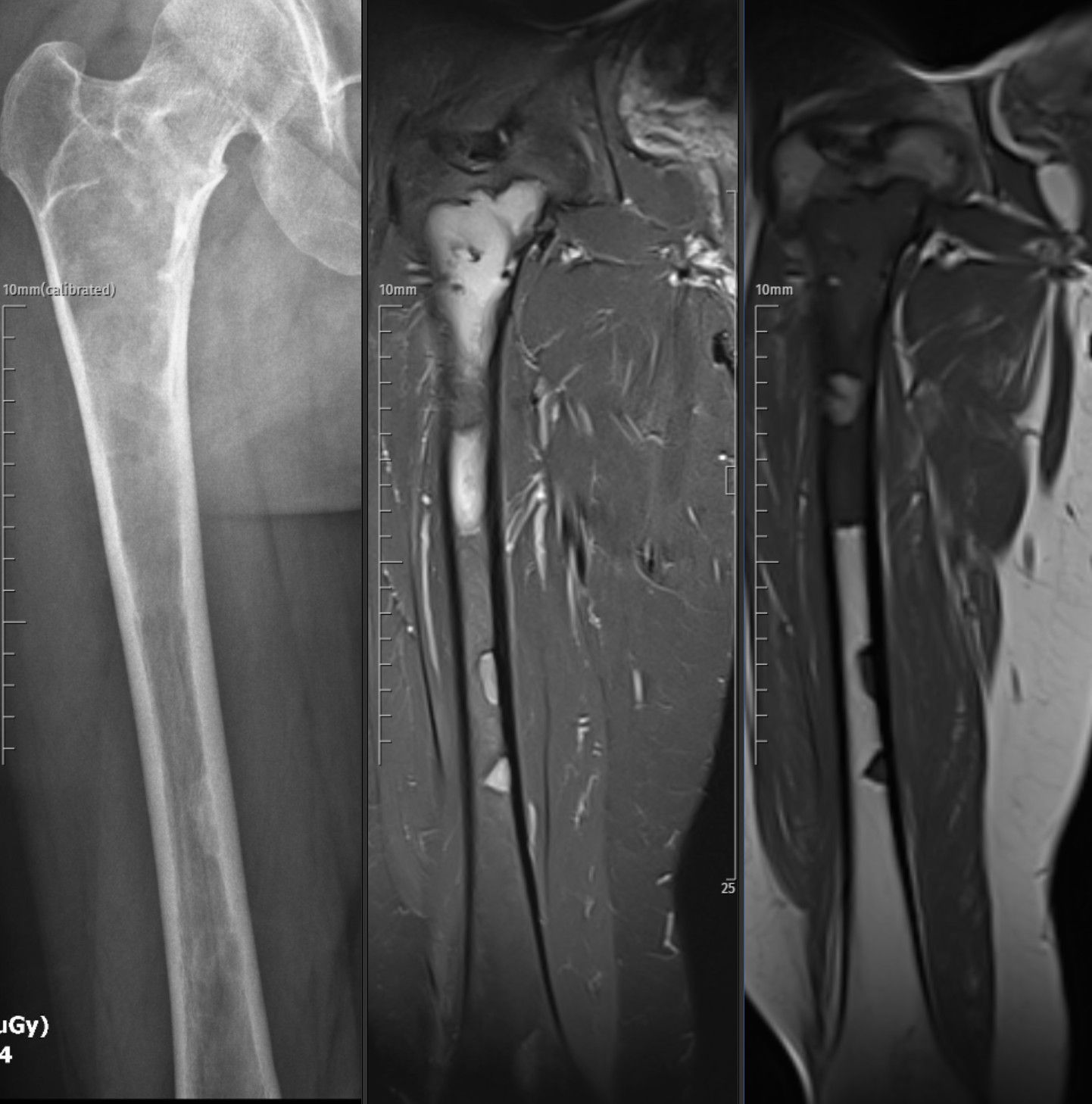 Radiograph and coronal MRI images of the proximal femur demonstrate a well-defined intramedullary expansile lesion with a ground-glass matrix and cortical thinning without periosteal reaction or soft-tissue extension. On MRI, the lesion shows heterogeneous low-to-intermediate signal on T1-weighted and high signal on fat-suppressed proton-density images, consistent with a fibrous dysplasia involving the proximal femoral shaft.