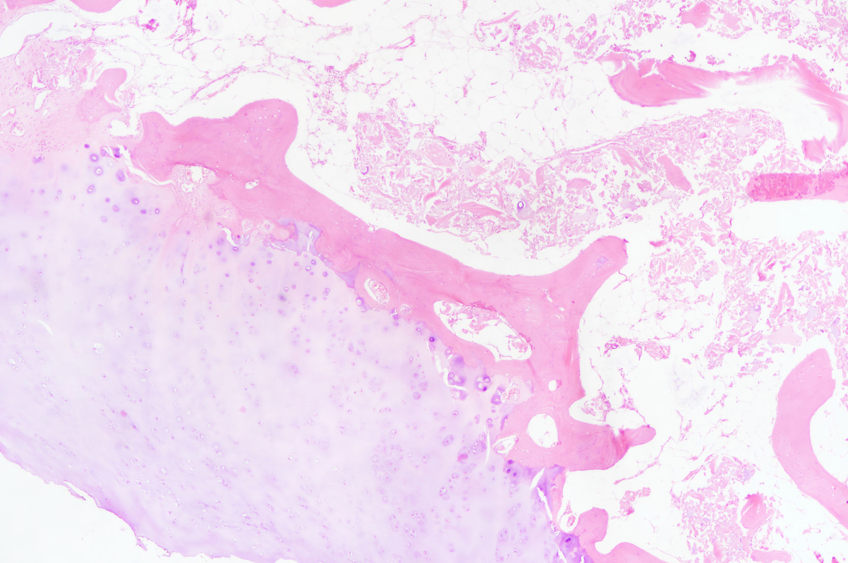 Osteochondroma pathology