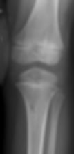 NOF at proximal tibia (AP view)