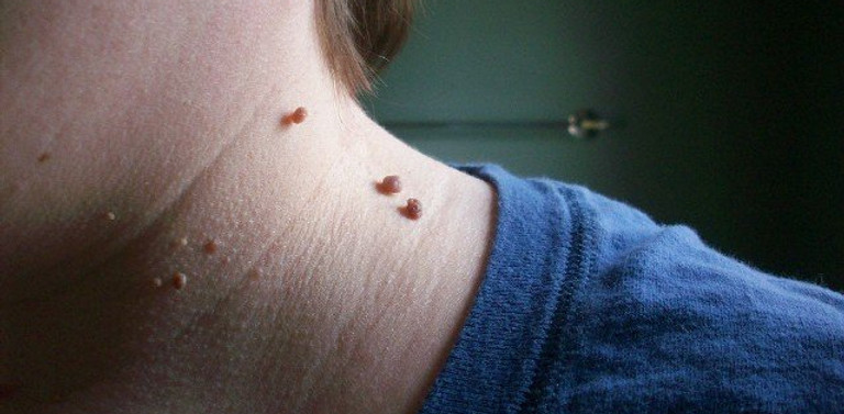Skin Tags
