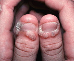 Warts in finger