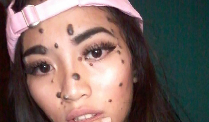 Moles on face