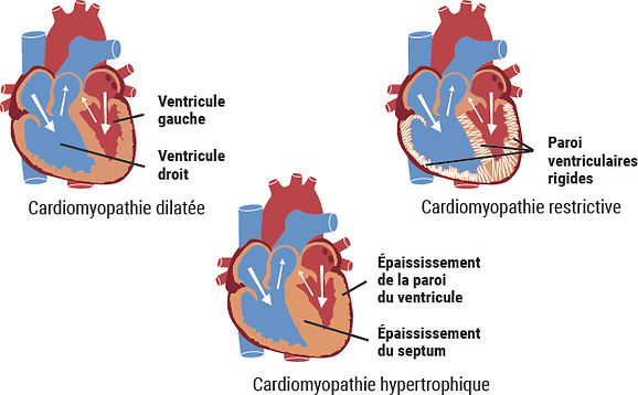 schema-cardiomyopathie.jpg
