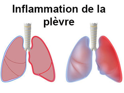pleurésie.jpg