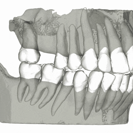 simulação da movimentação dental