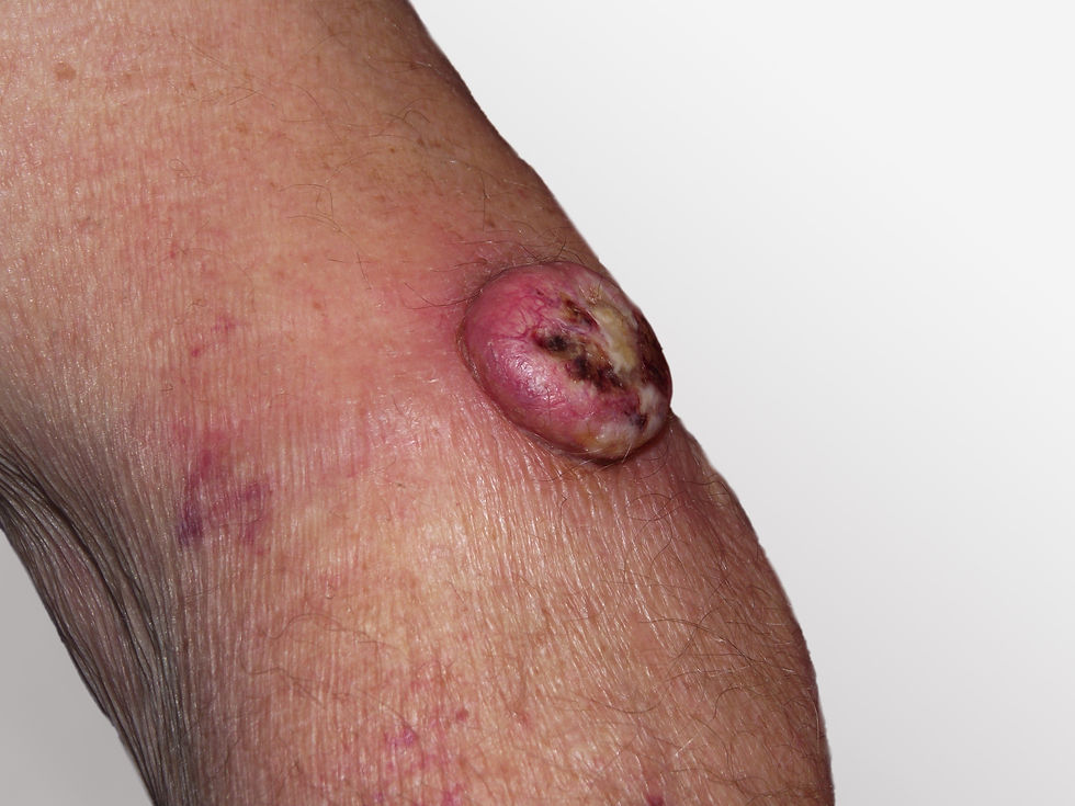 Large squamous cell carcinoma on arm. Glasgow Skin Specialists