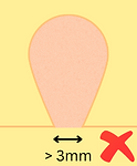 Large skin tag.png