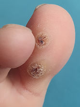 Wart before treatment