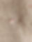 Skin tag SD 1979 1.jpg