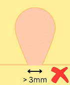 Large skin tag.png