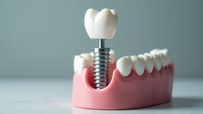 Discover the Best Dental Implant Options for a Brilliant Smile