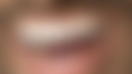 Guided Immediate Smile (GIS) : Retrouver un sourire complet immédiatement.