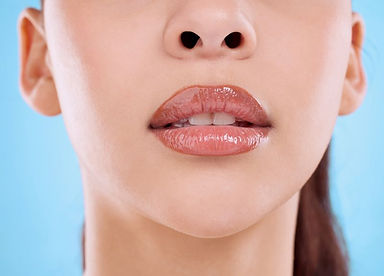 lips-after-filler.jpg