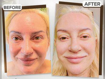 Before and after facial comparison showing smoother skin texture and reduced lines