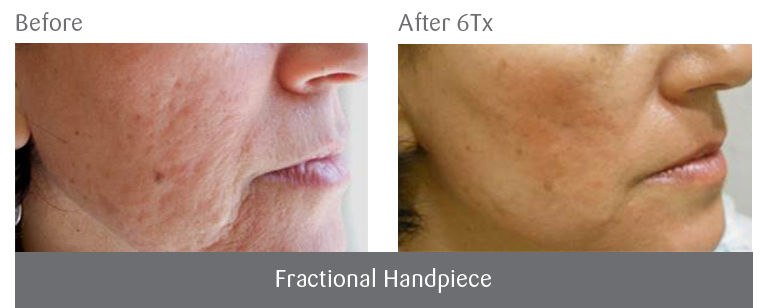 Viora V-touch Face Treatment