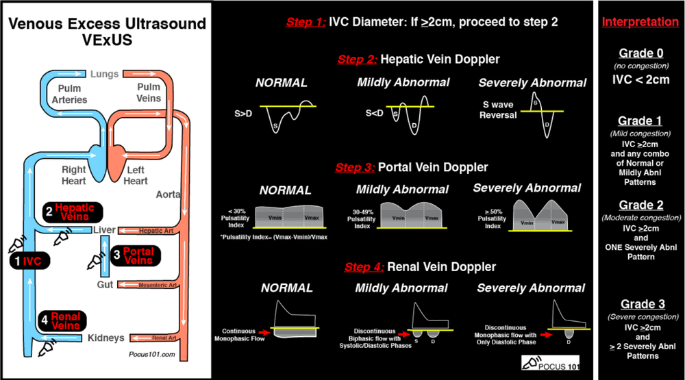 Right Heart Failure Understanding the hemodynamics Part 1 Preload