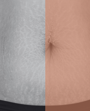 CURSO CAMUFLAGEM DE ESTRIAS