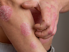 What is Eczema?