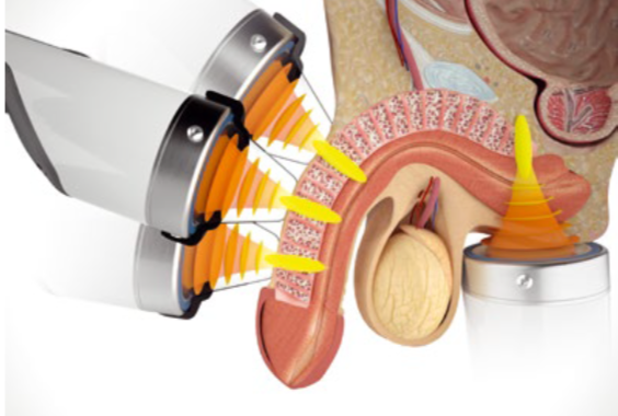 Miniatura: Erectile Dysfunction Shock Wave Therapy For Erectile Dysfunction