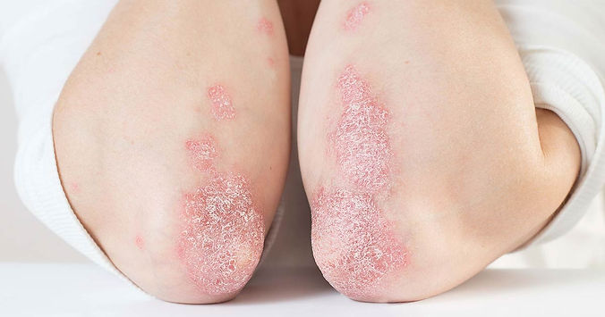 Psoriasis treatment options discussed at Hawaiian Islands Dermatology, a leading clinic in Kailua for comprehensive care.