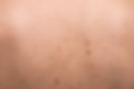 A Kailua dermatologist uses Sciton BBL (BroadBand Light) to target skin issues, promoting a more youthful appearance.