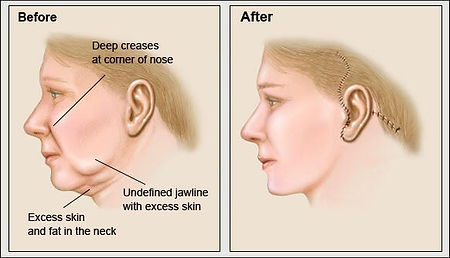 facelift.jpg