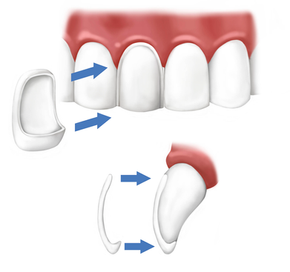 What are dental veneers?