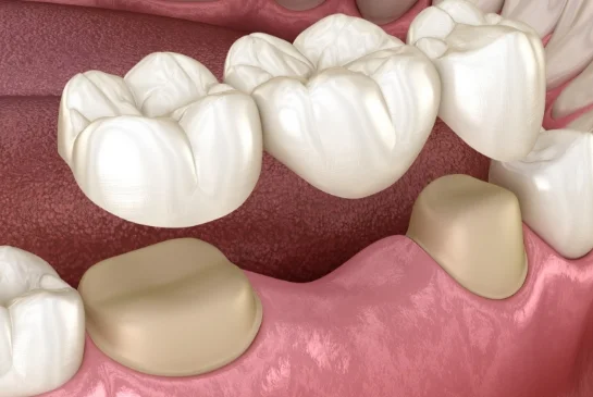 DENTAL BRIDGES IN NYC MIDTOWN