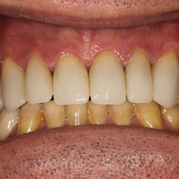 Restoration Root Canal