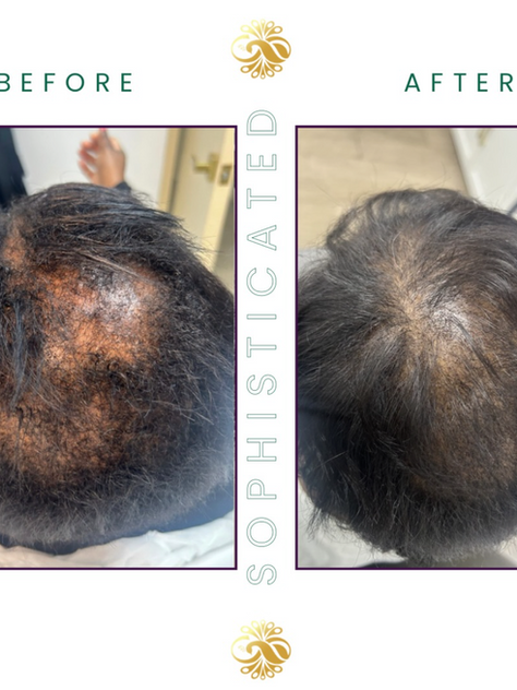 A client who experienced hair loss 