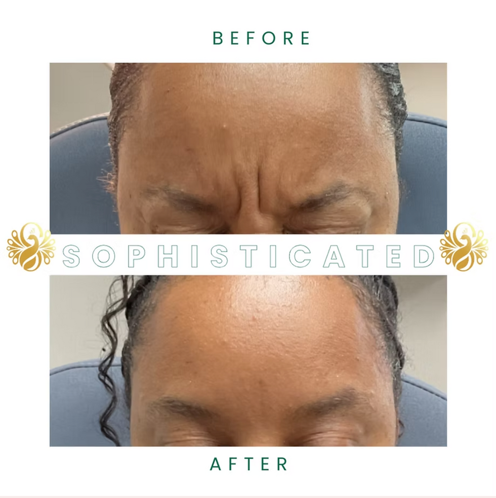 A neurotoxin injection before and after