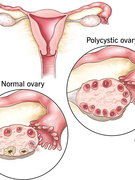 PCOS IS NOW PMOS. Here's Why That Matters: The name change that finally admits it was never really about ovarian cysts