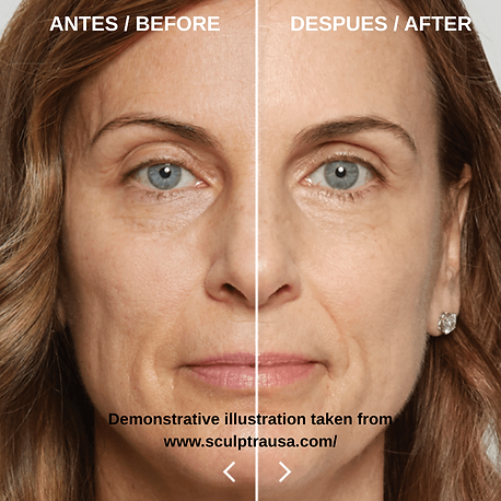 SCULPTRA RADIESSE EN BOGOTA.png