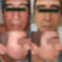 Laser dermatologico acne y manchas bogota.jpg