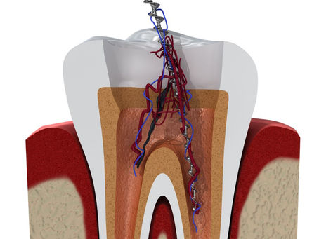 Signs You May Need a Root Canal: Springfield Dentists Explain the Warning Symptoms