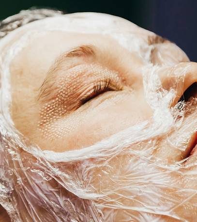 a woman prepared with numbing cream on the face for CO2 laser treatment
